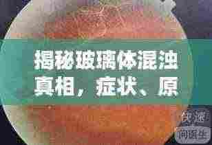 揭秘玻璃体混浊真相，症状、原因及治疗方法一网打尽！